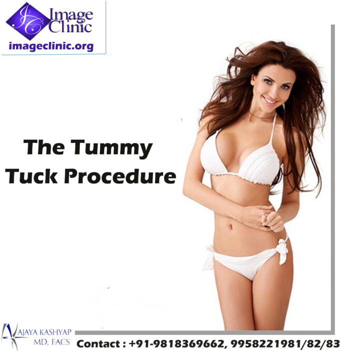 tummy tuck surgery, abdominoplasty surgery cost, weight loss surgeon, low cost surgery clinic, delhi, india